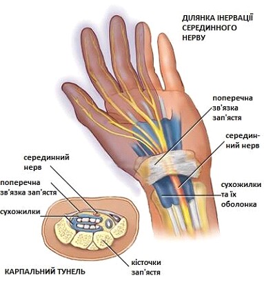 Німіють руки? Вихід є!