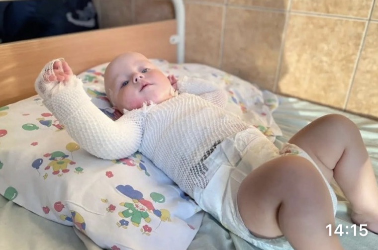 У Швейцарії рятують дев’ятимісячного хлопчика з Вінниччини, який отримав важкі опіки