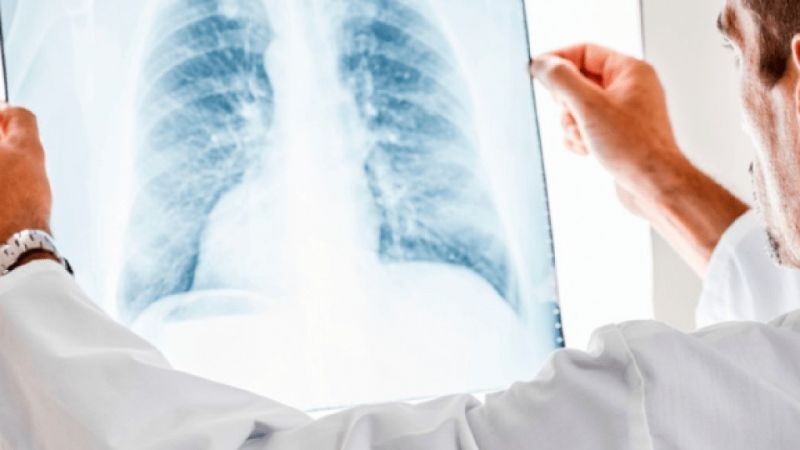 На Вінниччині побільшало хворих на туберкульоз