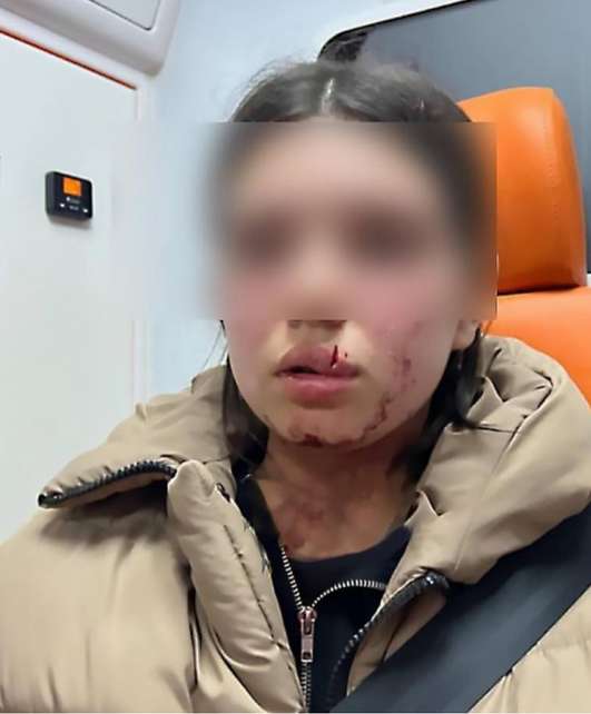 13-річна постраждала через кинутий камінь у Хмільницькій громаді