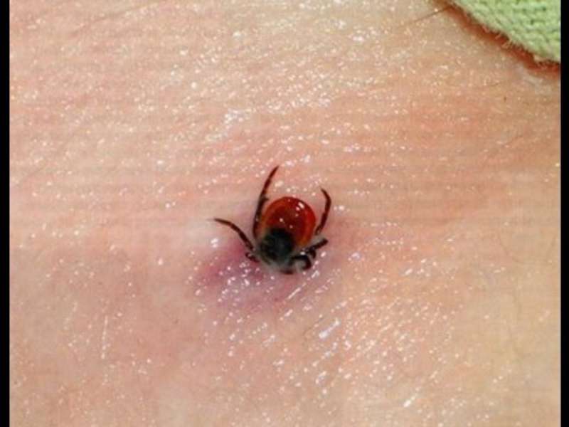 На Хмельниччині у 18 людей підтвердили хворобу Лайма