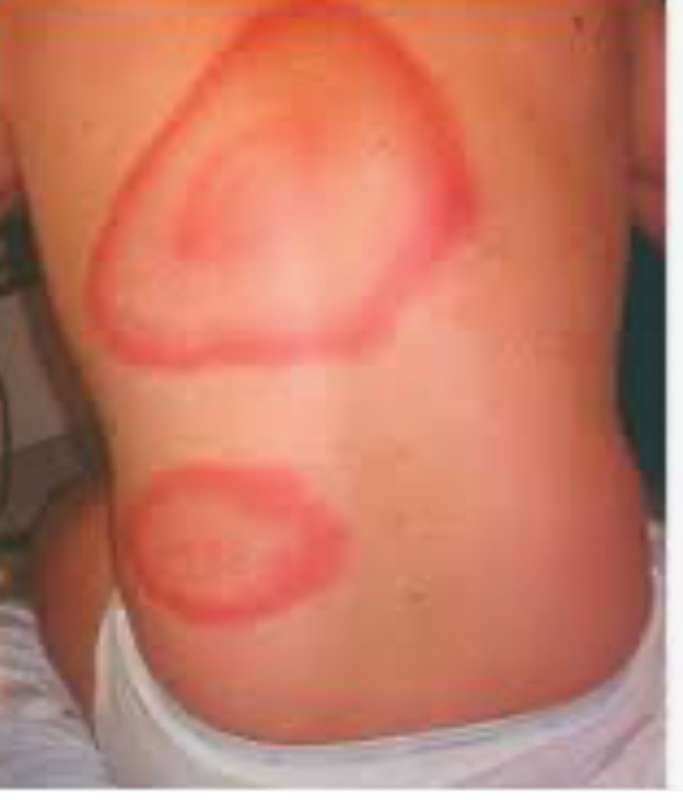 Малярію підтвердили на Вінниччині