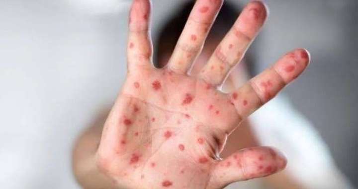 На Хмельниччині зафіксували спалах кору