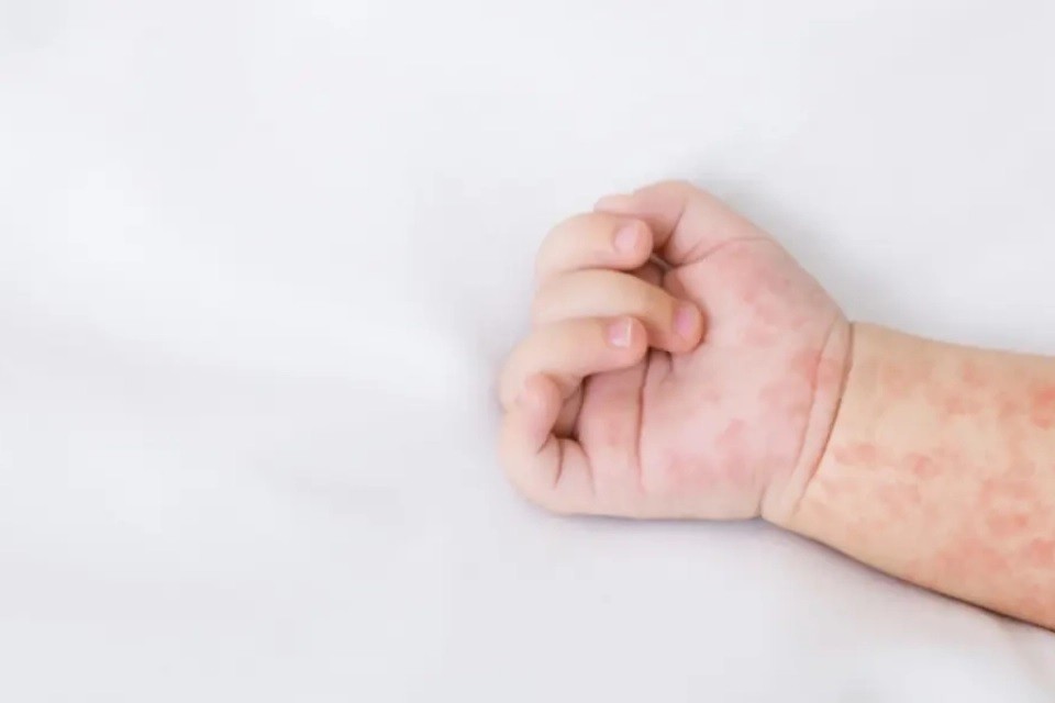 Стрімко зростає захворюваність на кір