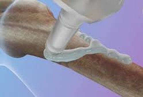 У Китаї винайшли клей для кісток — він може зростити переломи за хвилину, — ЗМІ