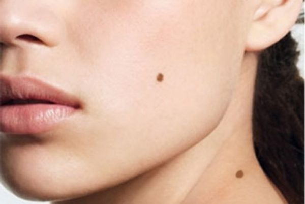 Що означають родимки на тілі?