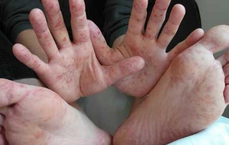 Новий небезпечний вірус Коксакі шириться Україною