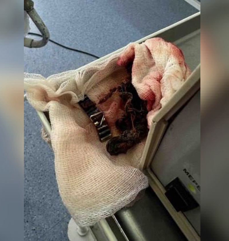 Медики дістали 12 магнітів із тіла дитини