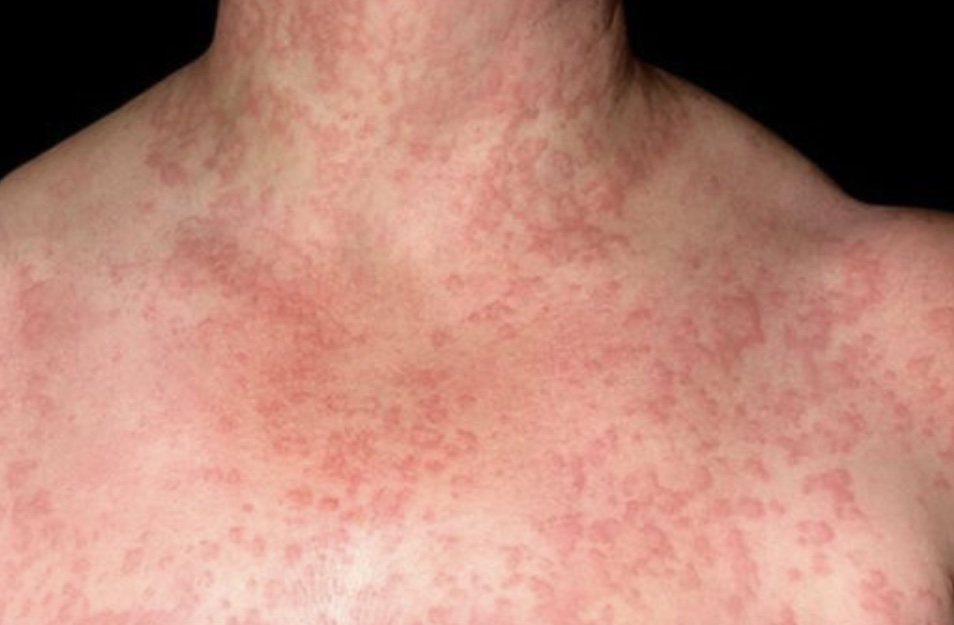 Причиною алергії може бути пологова травма!