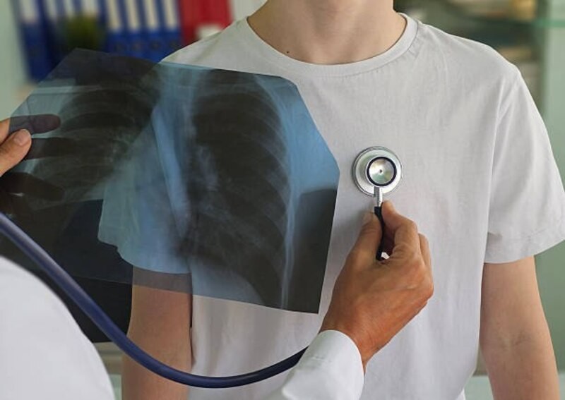 Фіксують випадки туберкульозу серед підлітків