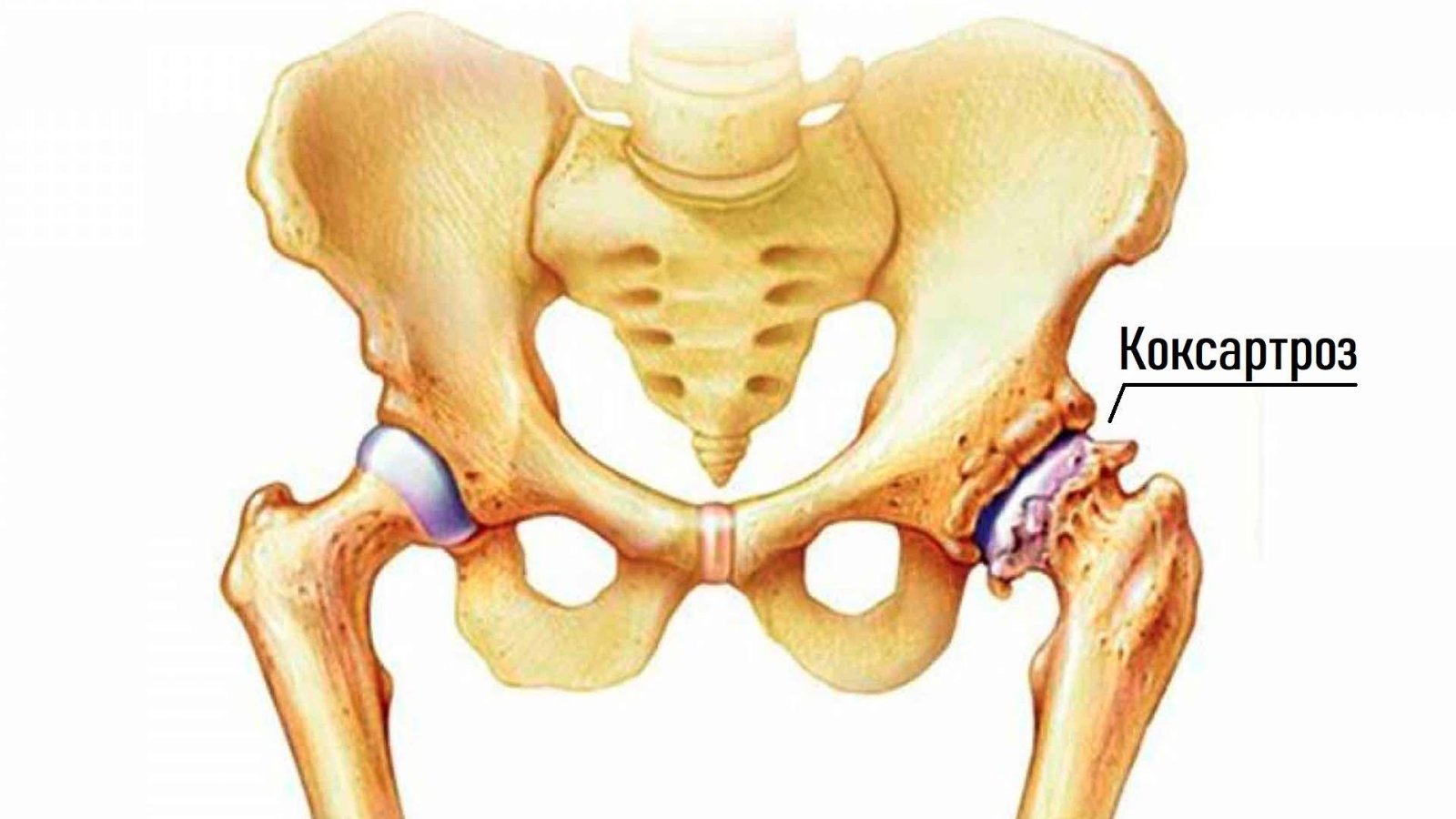 П’ять ранніх ознак коксартрозу.